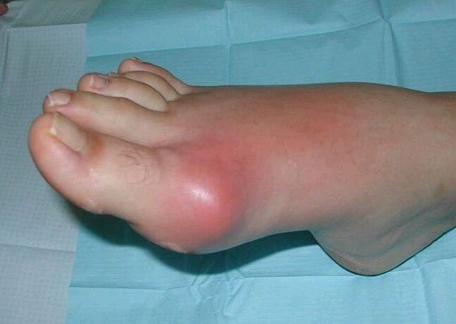 Κλινική εικόνα αρθρίτιδας ποδιών - οίδημα και φλεγμονή