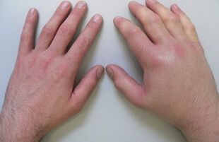 αρθραλγία ως αιτία πόνου στις αρθρώσεις των δακτύλων