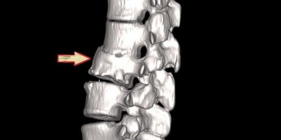 παθολογία της σπονδυλικής στήλης ως αιτία του πόνου στην πλάτη